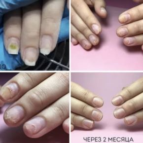 [Emi-school] Восстановление ногтей при заболевании (Екатерина Мирошниченко)